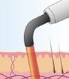 softlaser