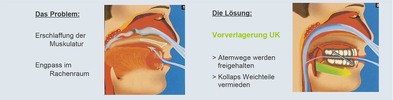 Schnarchtherapie Schema