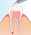 endodontie